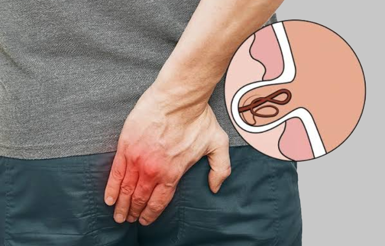 Laser-Pilonidal-Sinus-89